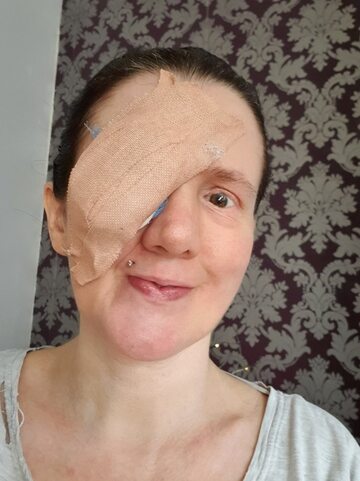 Claire Willis po amputacji oka