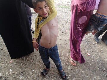 Dziecko syryjskich uchodźców pokazuje bliznę