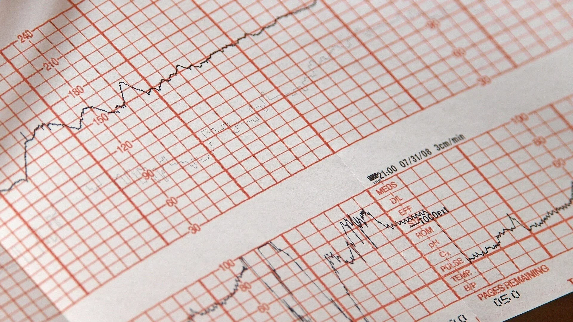 EKG