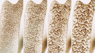 Etapy osteoporozy