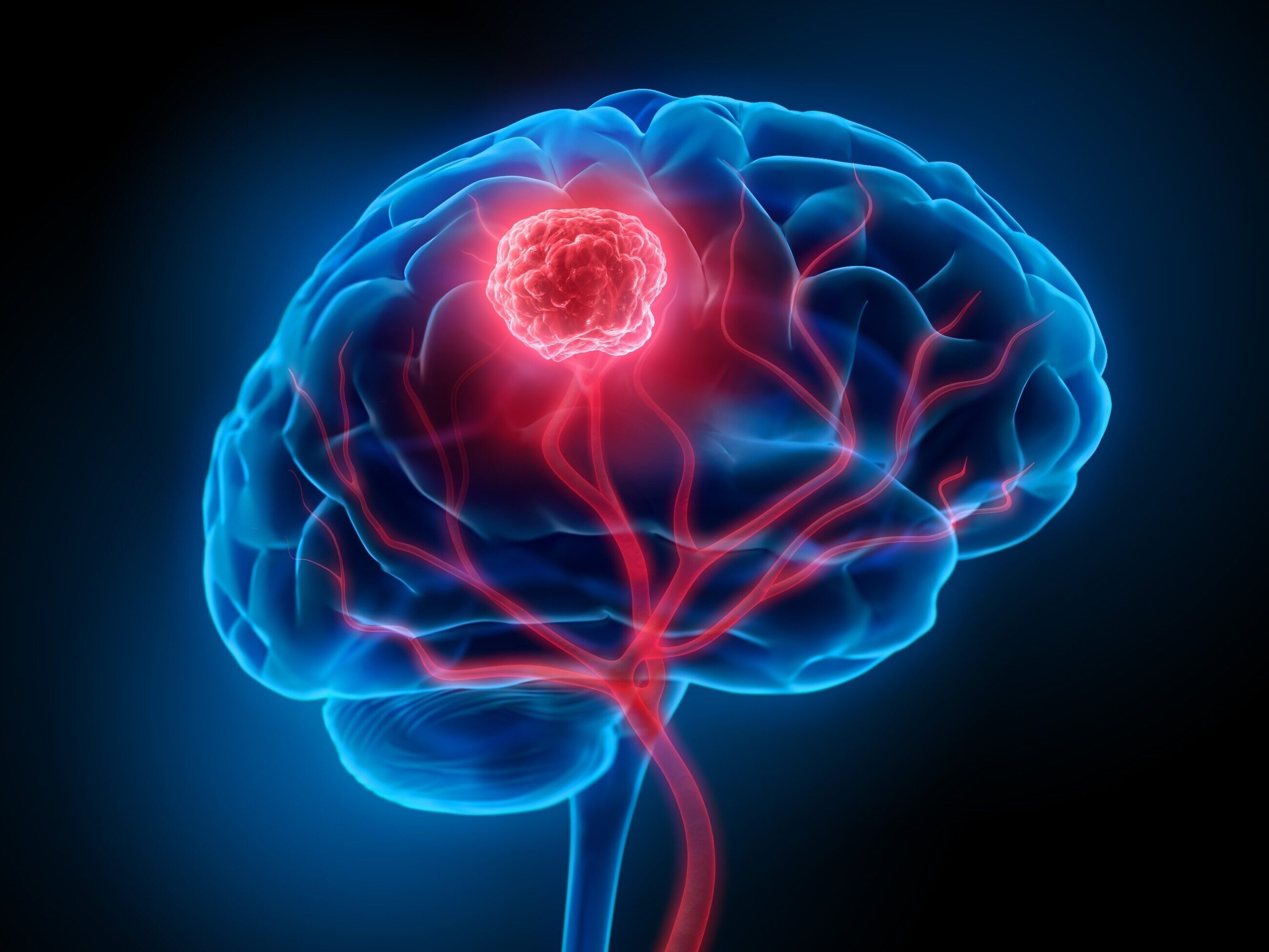Rak Mózgu Ile Się żyje Poznaj Jego Przyczyny Objawy I Sposoby Leczenia Zdrowie Wprost 4953