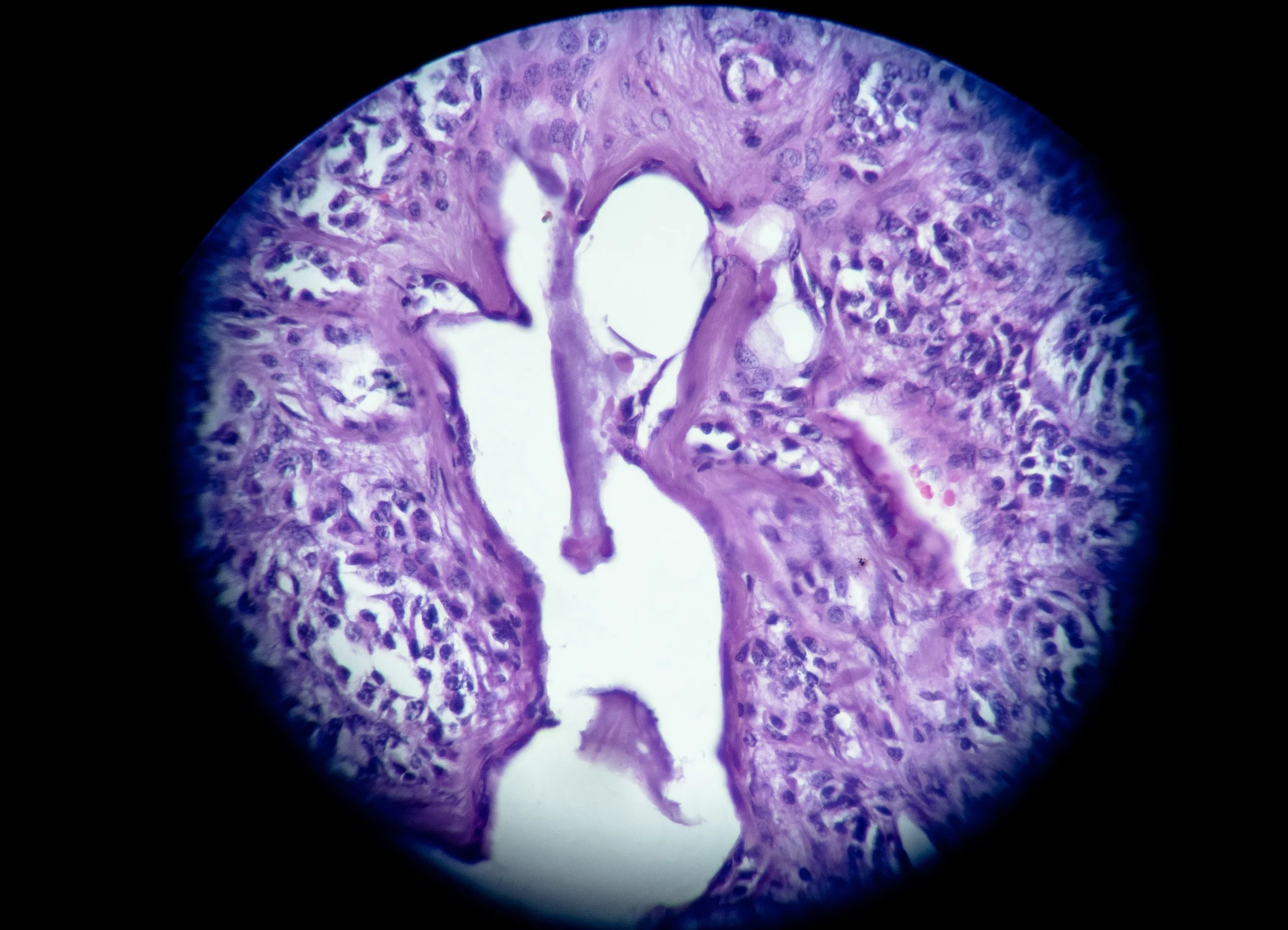 Nowotwór neuroendokrynny