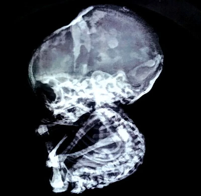 Lithopedion na zdjęciu rentgenowskim