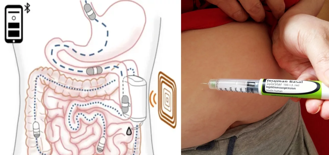 Nowy sposób na podawanie insuliny osobom cierpiącym na cukrzycę typu 1