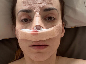 Marianna Schreiber przeszła operację nosa