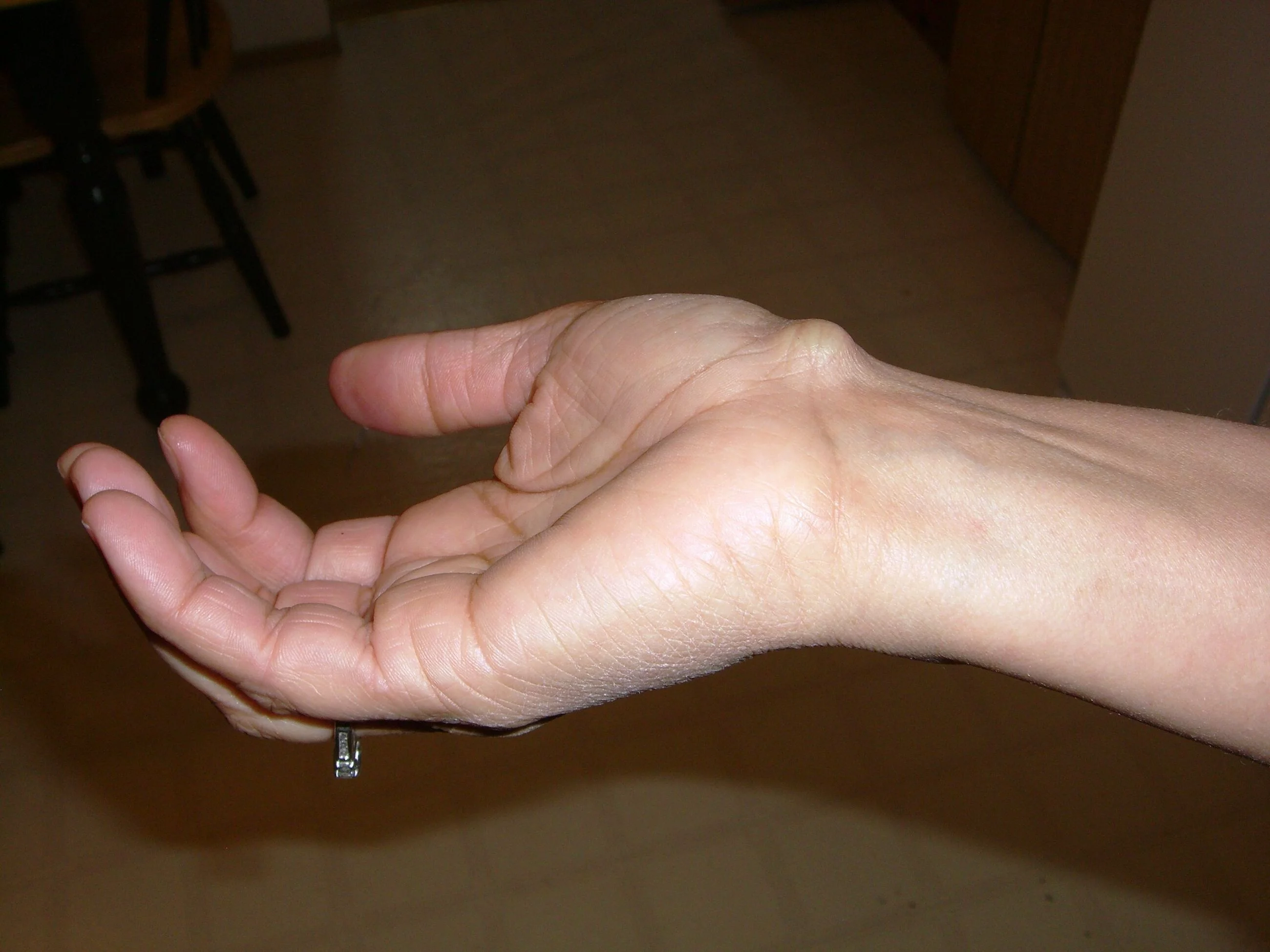 Torbiel galaretowata (ganglion)