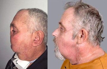 Maurice Desjardins przed i po przeszczepie