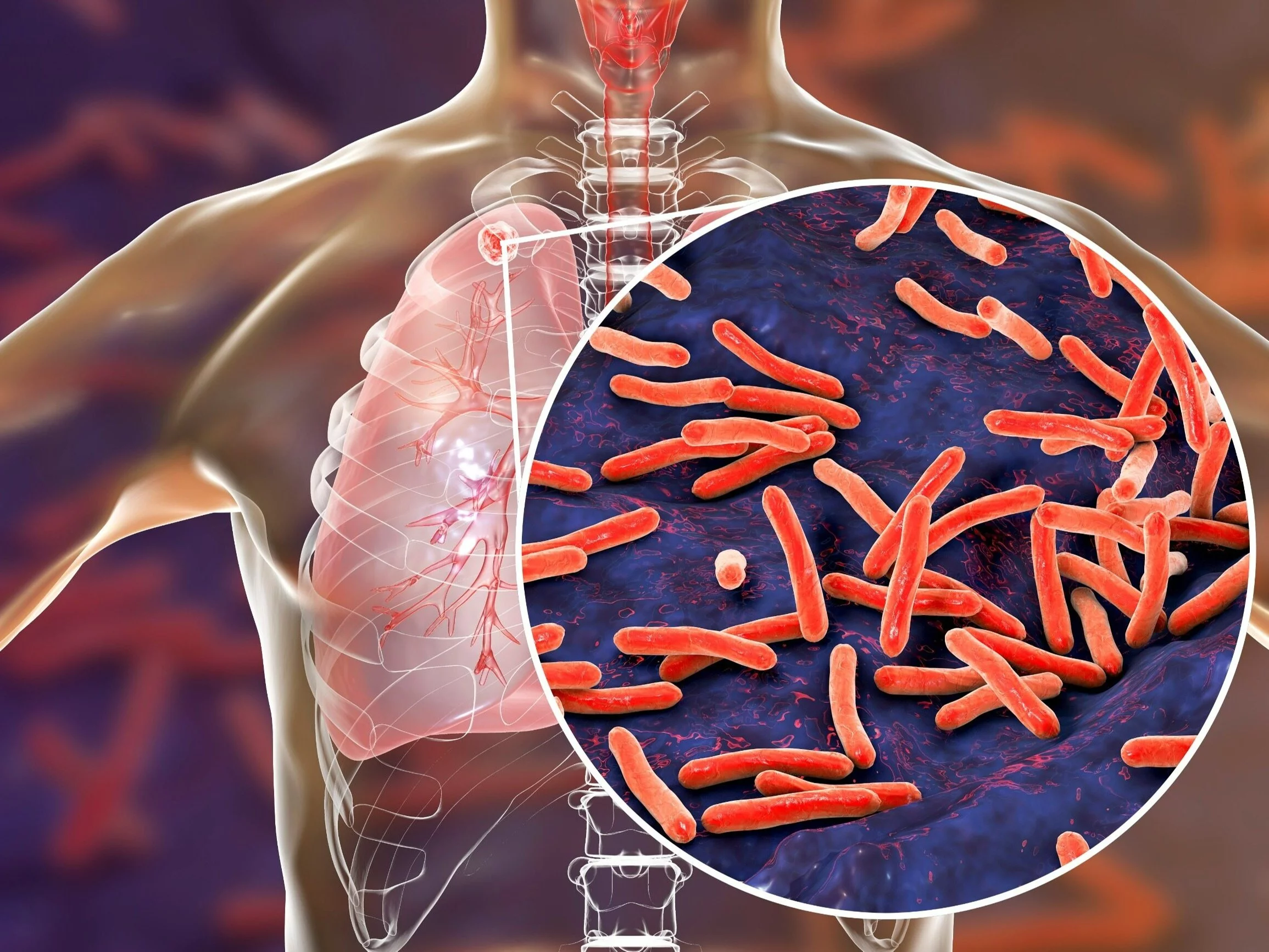 Nauczycielka chora na gruźlicę. choćby kilkuset uczniów może wymagać wizyty u lekarza