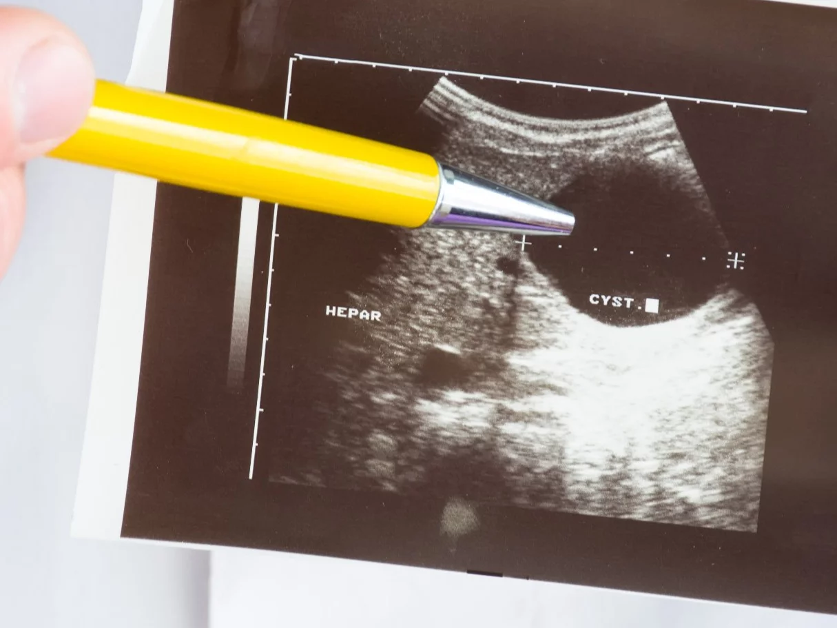 Zdjęcie ultrasonograficzne