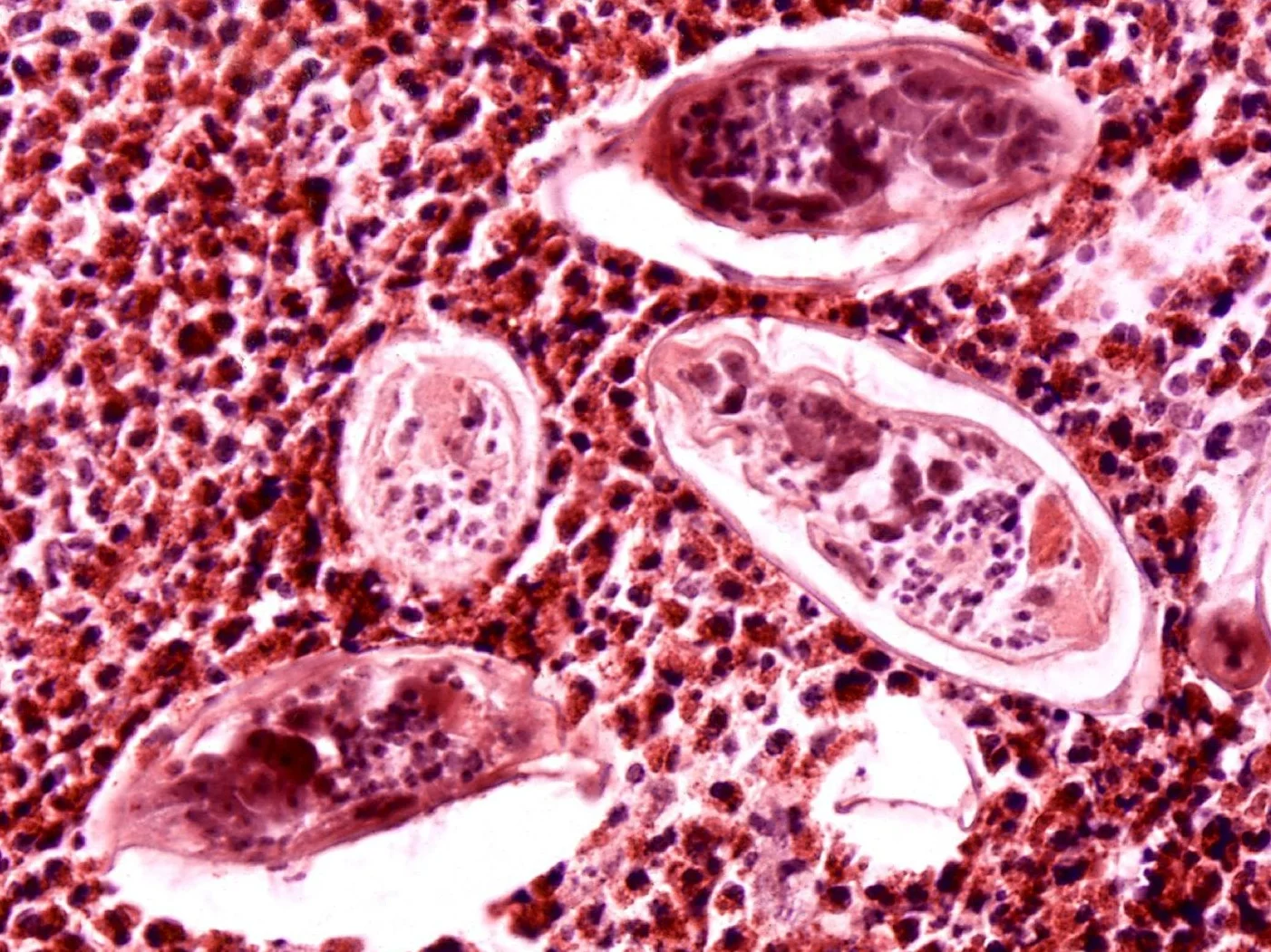Schistosomiasis haematobia, zdjęcie ilustracyjne