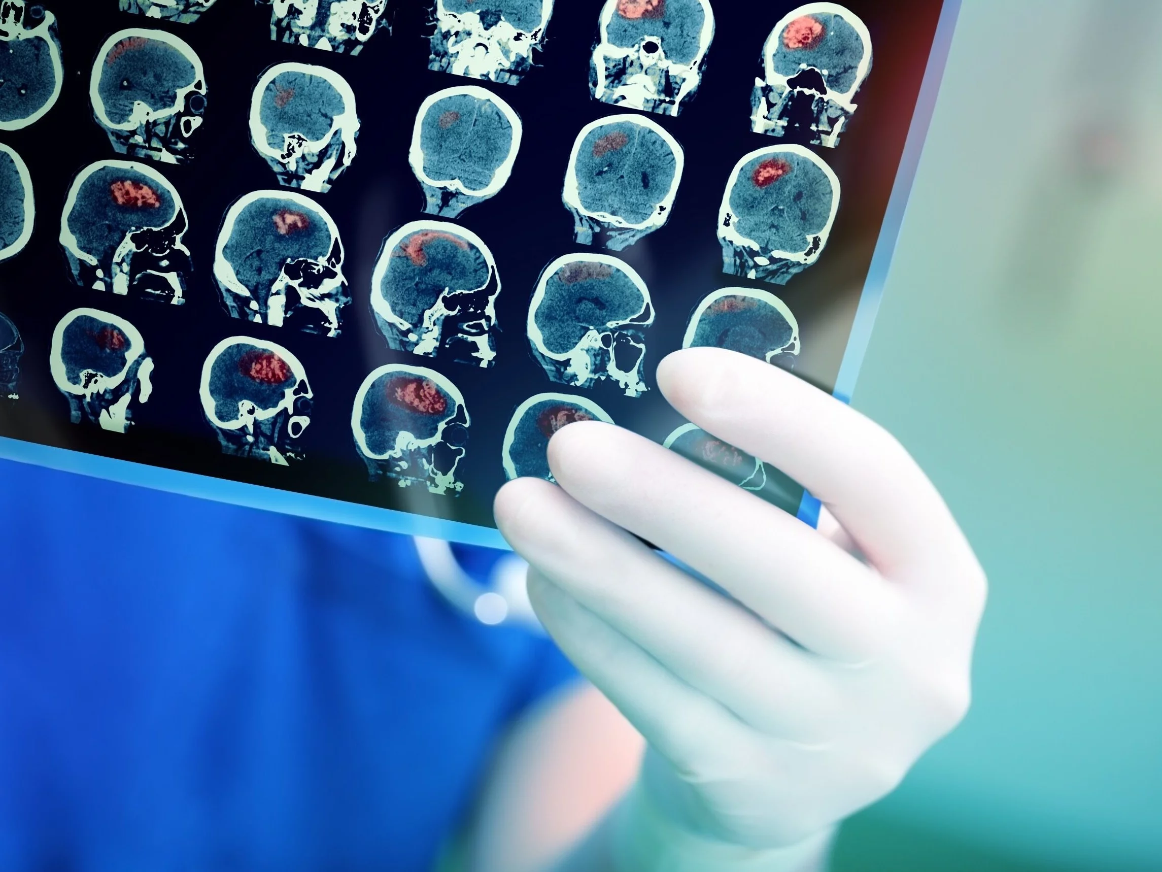 Nowa terapia cofa skutki Alzheimera. Lekarze mówią o rewolucji