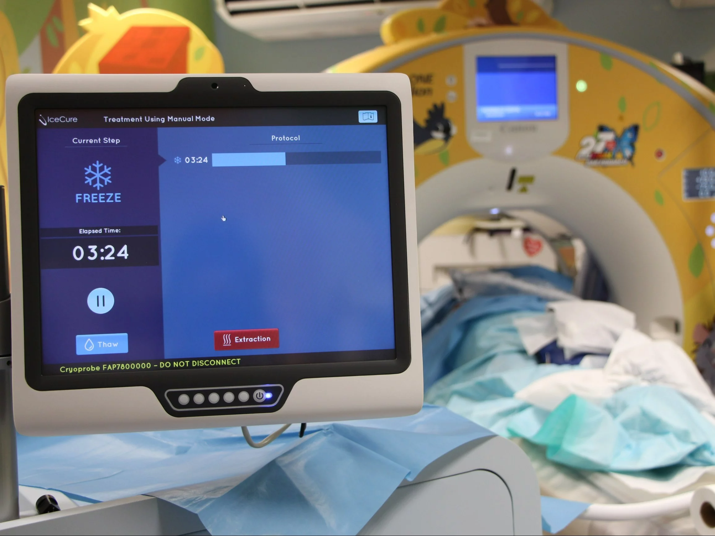 Krioablacja nowotworów nerek