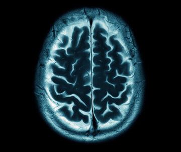 Optymalne leczenie stwardnienia rozsianego hamuje zanik mózgu