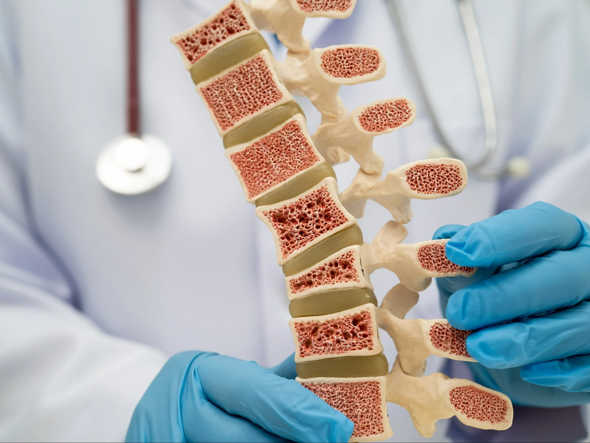 Osteoporoza