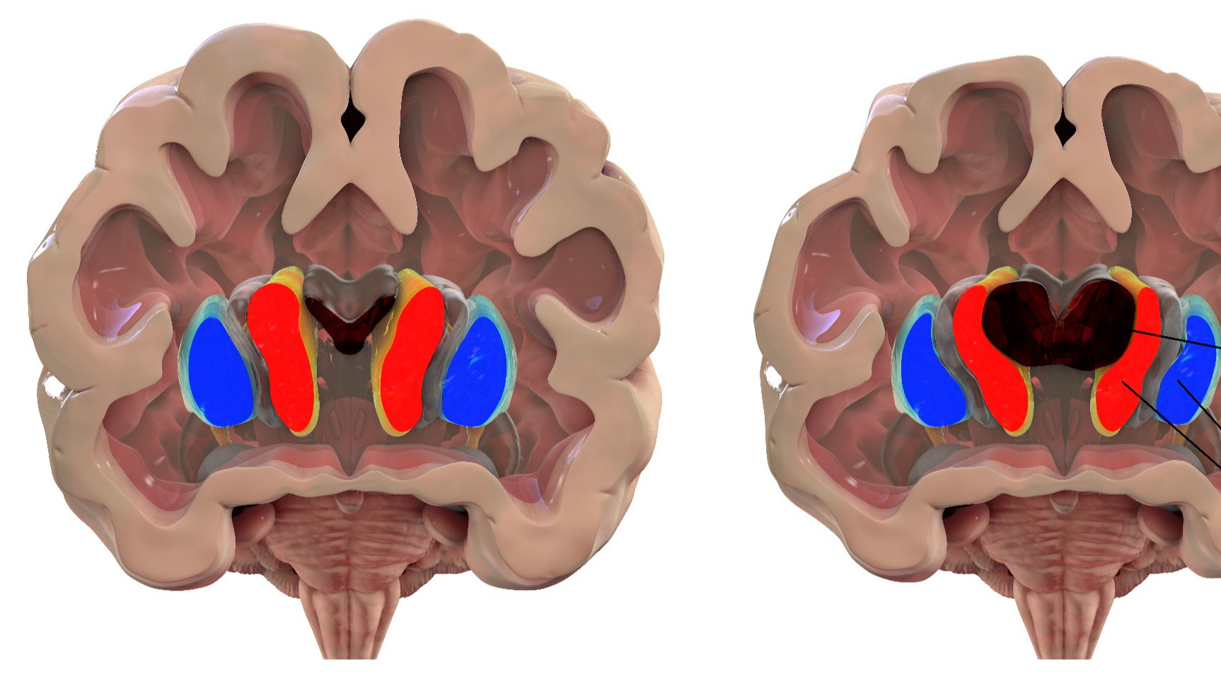 Nowa terapia nadzieją dla pacjentów? Na tę chorobę mózgu nie było sposobu