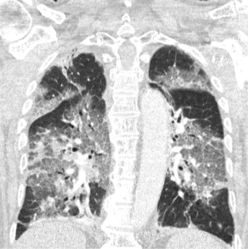 Płuca osoby chorej na koronawirusa