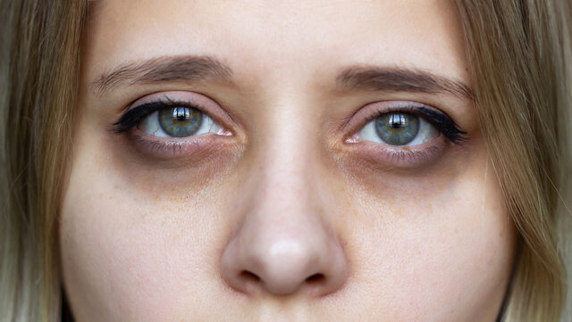 Podkrążone Oczy Objaw Choroby Czy Defekt Kosmetyczny Zdrowie Wprost 6605