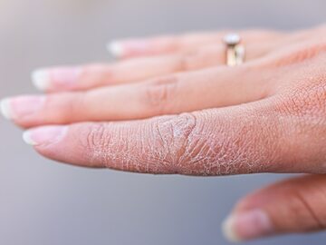 Popękana skóra rąk