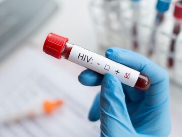 Pozytywny wynik testu na HIV. Zdjęcie ilustracyjne.