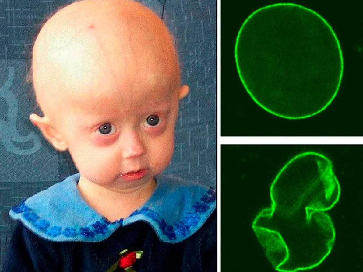 Progeria