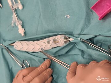 Przezskórna naprawa aorty piersiowo-brzusznej za pomocą modyfikowanego stent-graftu.
