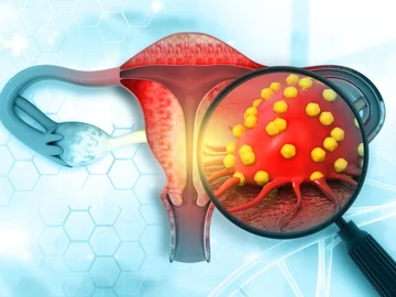 Rak endometrium (trzonu macicy)