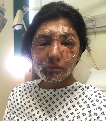 Resham Khan została oblana kwasem w dniu urodzin
