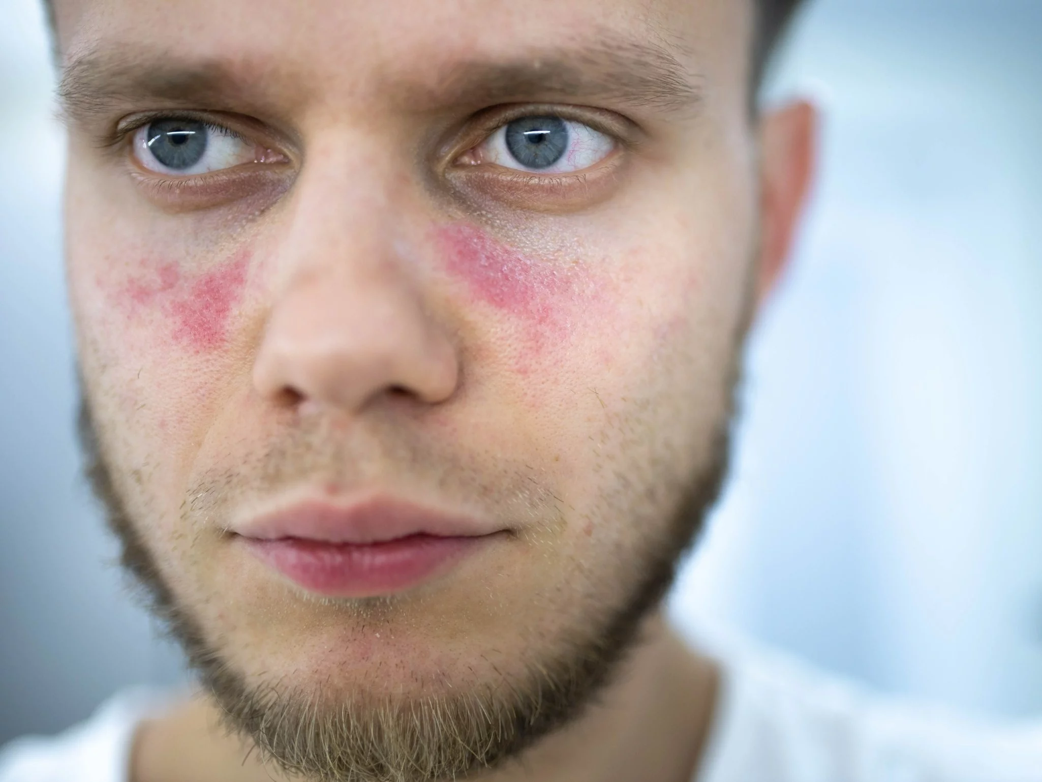 Toczeń rumieniowaty