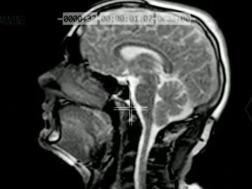 W mózgach chorych na schizofrenię ograniczeniu ulega autofagia (fot. sxc.hu)