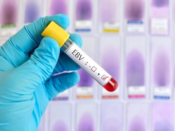 Wirus Epsteina-Barr – test diagnostyczny