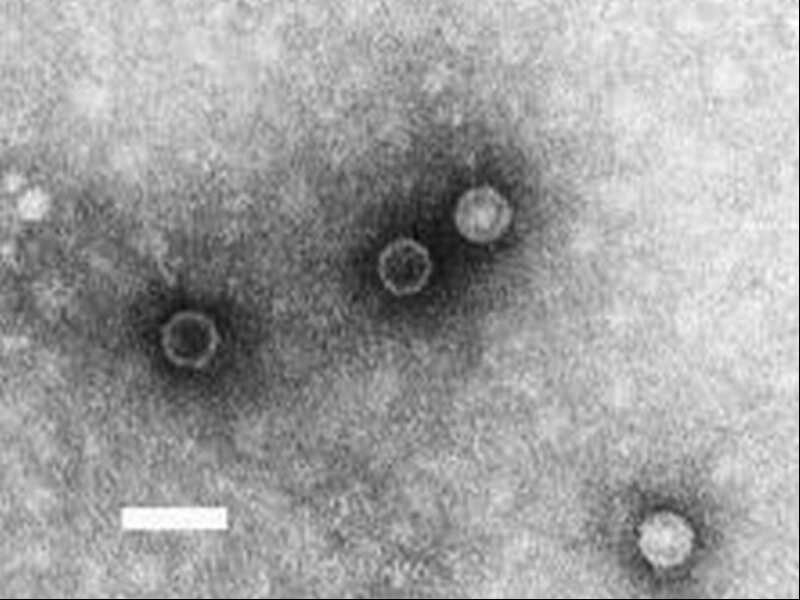 Enfermedad de Heine-Medina – historia de la poliomielitis, síntomas, causas y tratamiento – Zdroj y Prost
