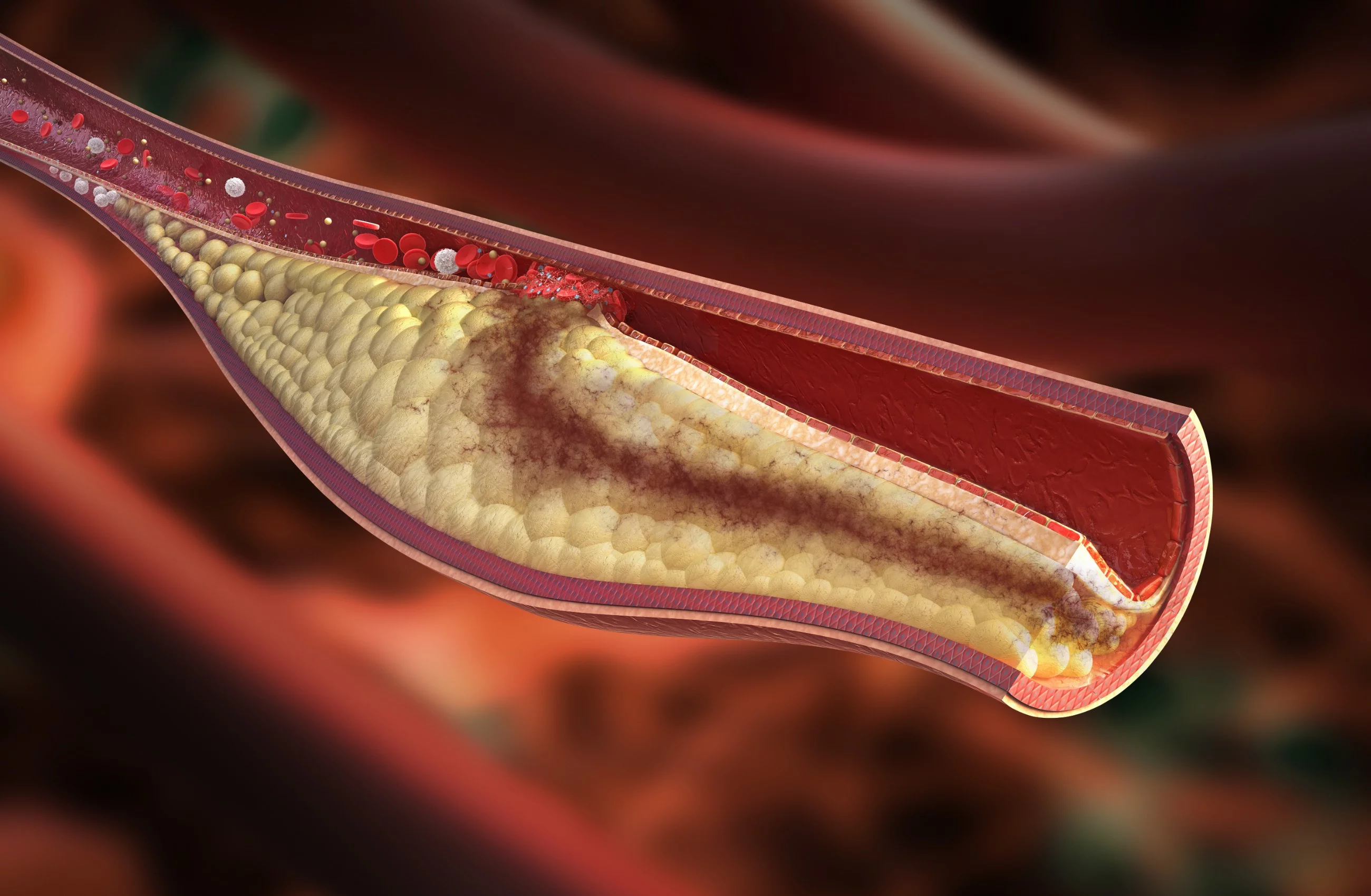 Cholesterol