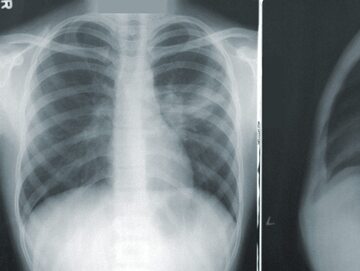 Zapalenie płuc na RTG